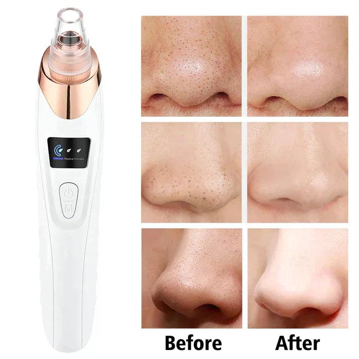 Electric Blackhead Remover (4 in 1) axent.pk